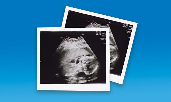 5 reasons NMT Ultrasound Film is your new go-to product for expectant mothers