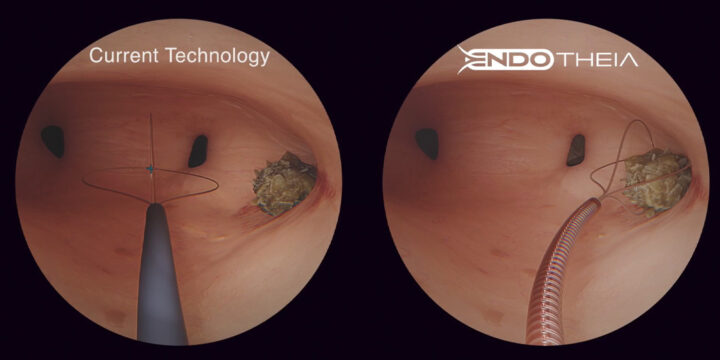 Breakthrough in Kidney Stone Treatment: Nissha and EndoTheia Unveil FlexStone™ Basket