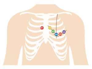 12 Lead ECG Placement