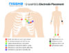 Printable ECG Electrode Placement Guide - Nissha 360